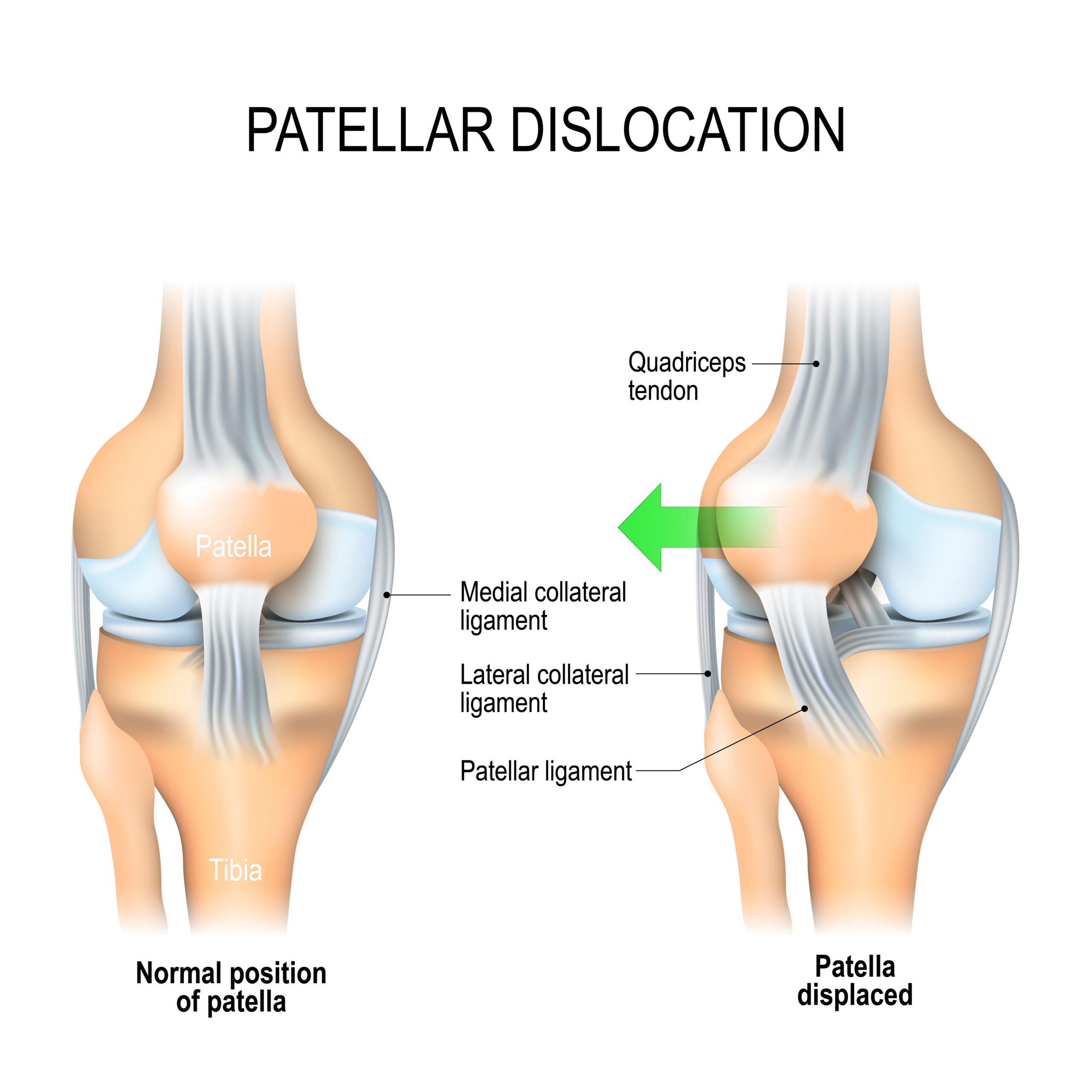 Patellar dislocation